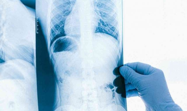 Akciğer kanserinin 10 belirtisi