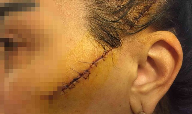 Eski sevgilisinin yüzünü usturayla kesen adam tutuklandı