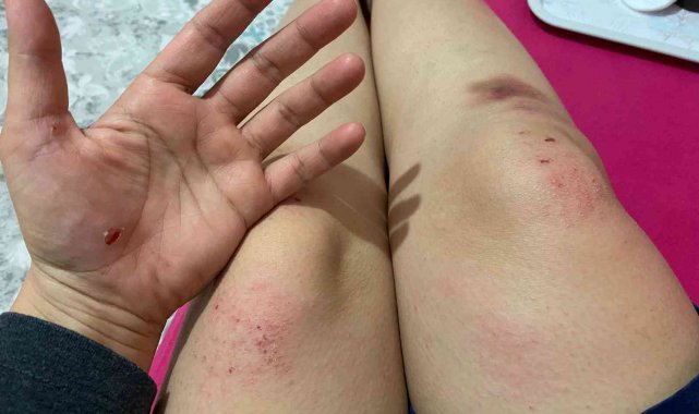 İşe giden kadına köpekler saldırdı