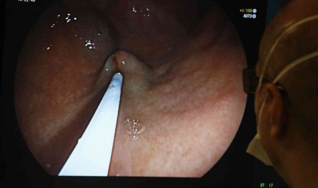 Mide botoksunda 15 dakikalık işlemle hastalar rutin yaşamlarına devam ediyor