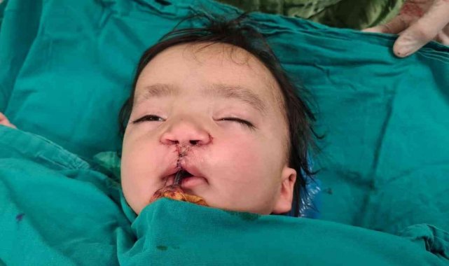 Yarık damak ve dudaklı bebeğe "Türk lalesi" ameliyatı