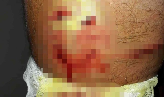 Yürüyüş yaparken sokak köpeklerinin saldırısına uğradı