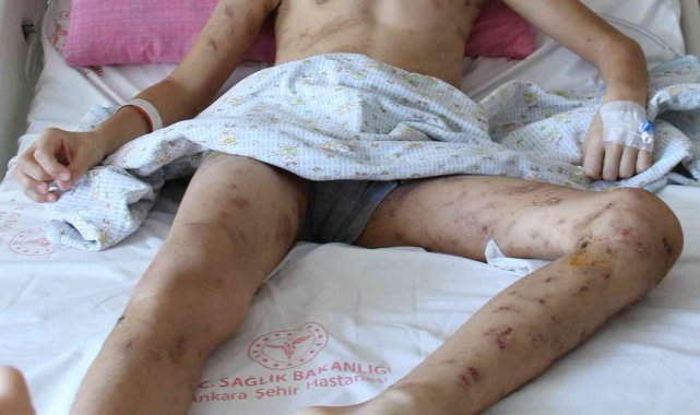 10 köpeğin saldırısına uğrayan 12 yaşındaki Enes, 9 cerrahi operasyon geçirdi, 6-7 tane daha geçirmesi planlanıyor