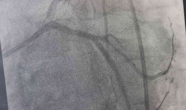 Dünyada yılda 500 bin insanın ölümü trans yağlardan