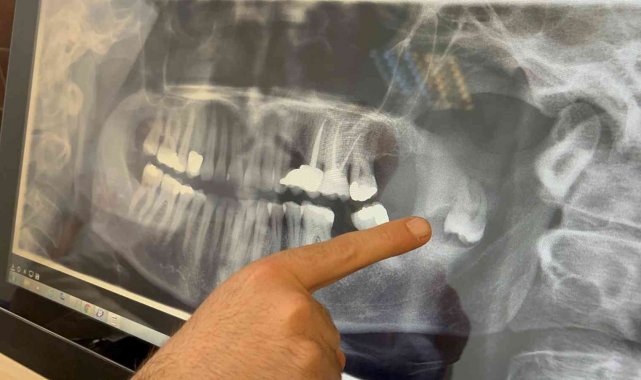 Kalıcı yüz felci olmaktan bu operasyonla kurtuldu