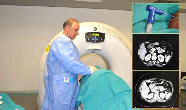 Karaciğer kanseri tedavisinde 'Mikrodalga Ablasyon' yöntemi