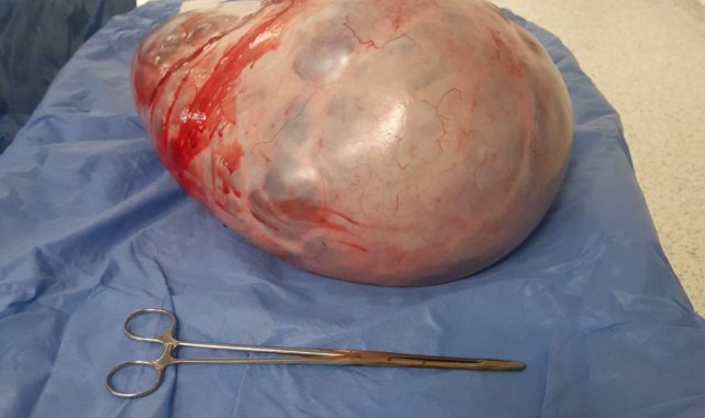 Karnından 9 kilo tümör çıktı