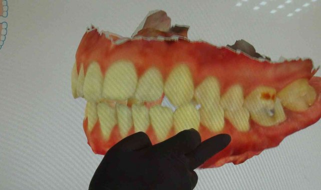 Korona virüs diş ağrılarını arttırdı