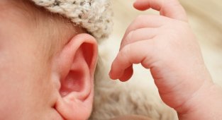 Silikon kalıplar ile kulak bozuklukları haftalar içinde düzeltiliyor