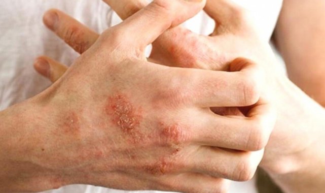 Soğuk havalarda egzamaya dikkat