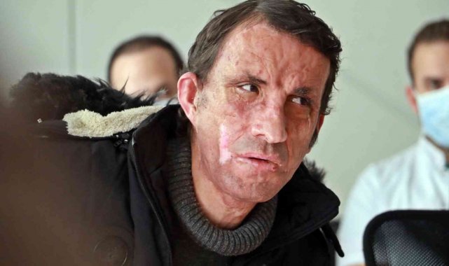 Türkiye'nin ilk yüz nakli 10 yaşında