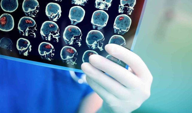 Yeni cerrahi teknolojiler beyin tümörü ameliyatlarındaki başarıyı artırıyor