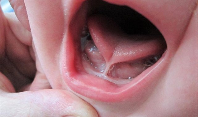 "Dil bağı bebeklerde ciddi gelişim sorunlarına yol açabiliyor"