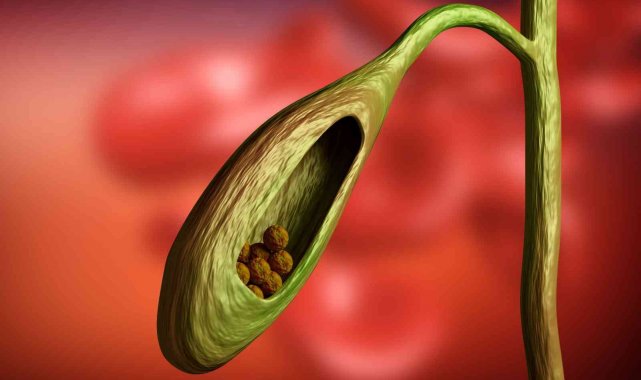 Safra kesesi taşını mide ağrısı ile karıştırmayın