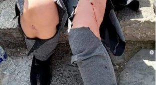 Köpeklerin Saldırısına Uğradı..