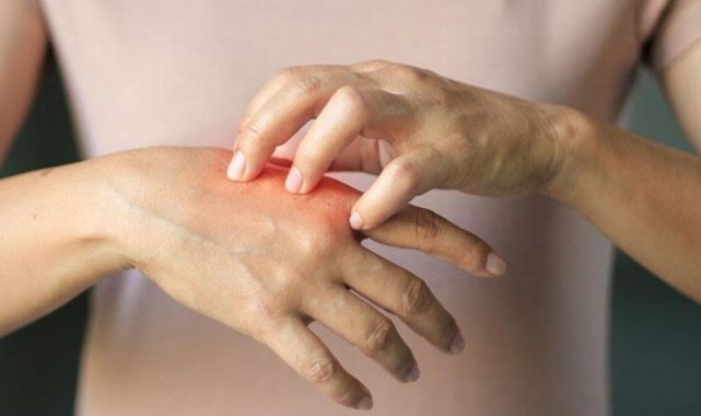 Soğuk yanıklarına dikkat; Kaşınma, morarma ve ağrı olabilir