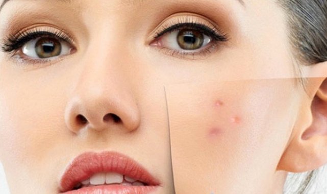 Hassas ve alerjik ciltlere mevsim geçişlerinde dikkat