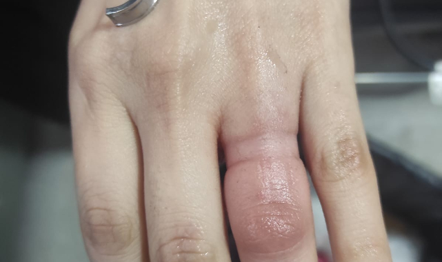 Parmağından çıkaramadığı yüzüğü itfaiye ekipleri çıkardı