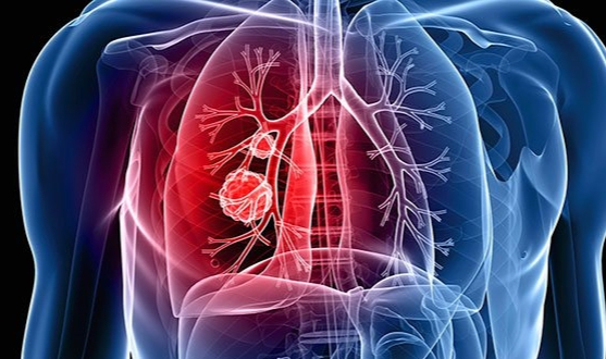 Şok eden sonuç.. Her 6 ölümden 1&#039;i kanser kaynaklı