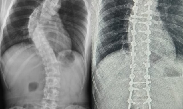 Tokat'tan gelen skolyoz hastası Samsun'da şifa buldu