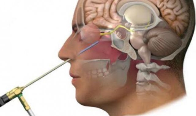 Yalova'da İlk kez Özel Atakent Hastanesi'nde kapalı yöntemle endoskopik hipofiz cerrahisi uygulandı