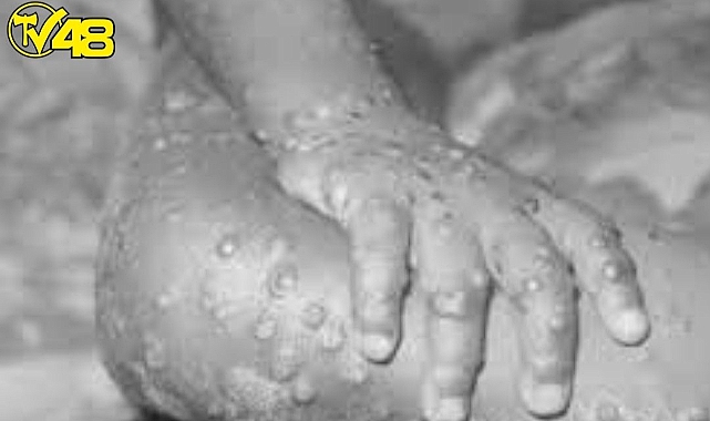 Maymun çiçeği virüsü 4 ülkeye daha sıçradı