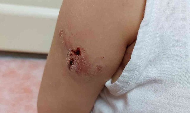 Zonguldak'ta sahipsiz köpekler 5 yaşındaki çocuğa saldırdı