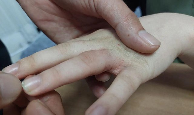 15 yaşındaki gencin parmağına sıkışan yüzüğü AFAD ve sağlık ekipleri çıkardı