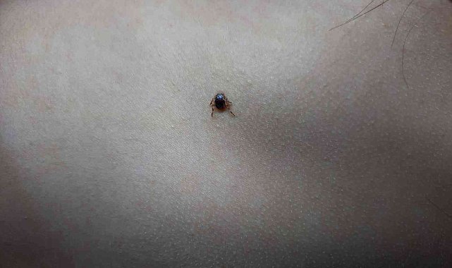 Çocuğun sırtındaki kene hastanede çıkartıldı