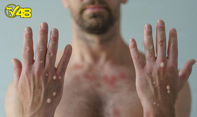 DSÖ Açıkladı; Maymun Çiçeği En Fazla Hangi Ülkede ?