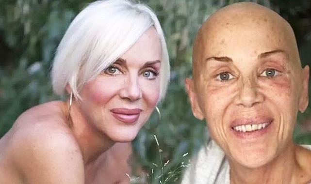 Billur Kalkavan kanserle mücadele ediyor... &#039;Kafamdan saç bile çıkıyor&#039;