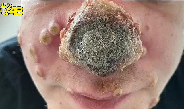 Maymun çiçeği hastalığı bu hale getirdi