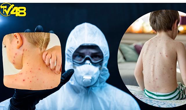 Yeni salgın alarmı: Domates gribi (Domates gribi belirtileri neler?, bulaşıcı mı? tedavisi var mı?)