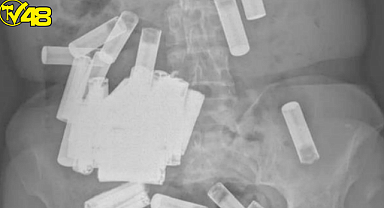 Doktorları şaşkına çeviren vaka! İrlandalı yaşlı kadının içinden 55 tane pil çıktı