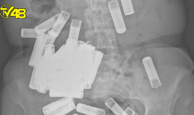 Doktorları şaşkına çeviren vaka! İrlandalı yaşlı kadının içinden 55 tane pil çıktı