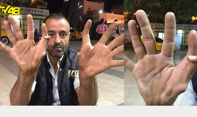 Oğlu 13, kızı da 11 parmaklı! Kendisini gören şaşkına dönüyor