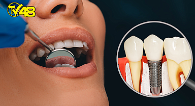 İMPLANT HAKKINDA DOĞRU BİLİNEN YANLIŞLAR