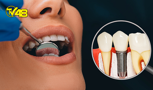 İMPLANT HAKKINDA DOĞRU BİLİNEN YANLIŞLAR