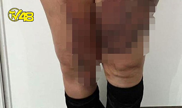 Yağlarını aldırdı hayatı kabusa döndü!