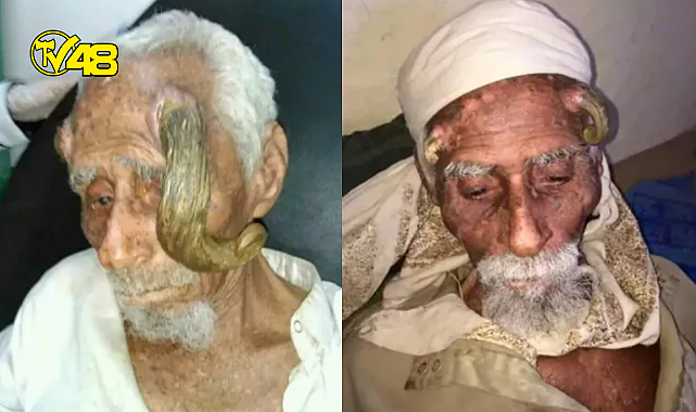100 yaşından sonra başında boynuz çıkan Yemenli Ali hayatını kaybetti! Sebebi ise boynuzları oldu
