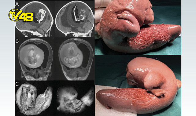 Çin&#039;deki 1 yaşındaki kızın beyninden doğmamış ikizi çıkarıldı