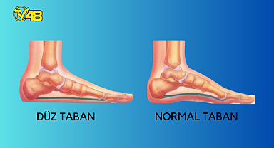DÜZTABANLIK NEDİR ? NE GİBİ ŞİKAYETLERE YOL AÇAR ?