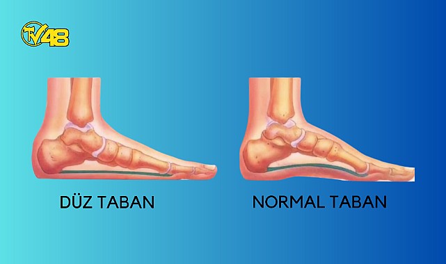 DÜZTABANLIK NEDİR ? NE GİBİ ŞİKAYETLERE YOL AÇAR ?