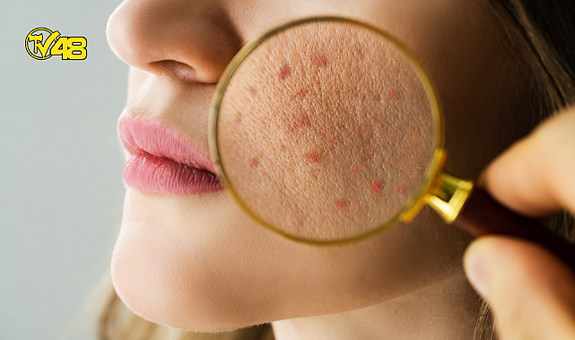 AKNE PROBLEMİ OLANLAR BU BESİNLERE DİKKAT!