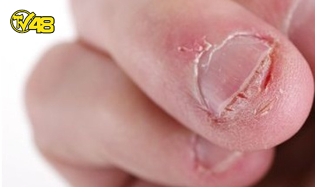 TIRNAK YEME ALIŞKANLIĞI NEDEN OLUR