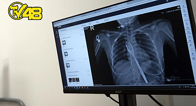 SÖKE'DE 18 YAŞINDAKİ GENÇ KIZ 18 SANTİMLİK ÇATAL YUTTU