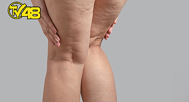 KADINLARIN GİZLİ DÜŞMANI: LİPÖDEM!