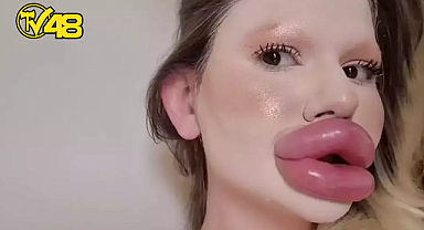 EN BÜYÜK DUDAK UĞRUNA 32 AMELİYAT GEÇİRDİ