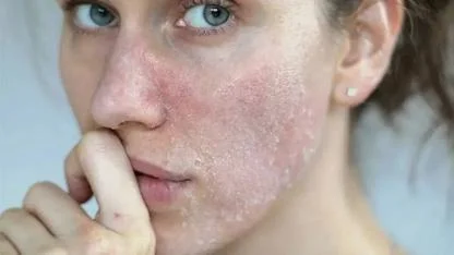 Uzmandan Kış Uyarısı: Çok Sıcak Duş Cildi Kurutuyor